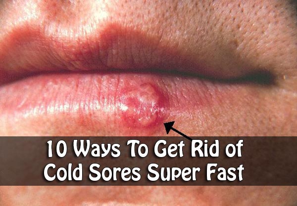 10 Ways To Get Rid Of Cold Sores Super Fast